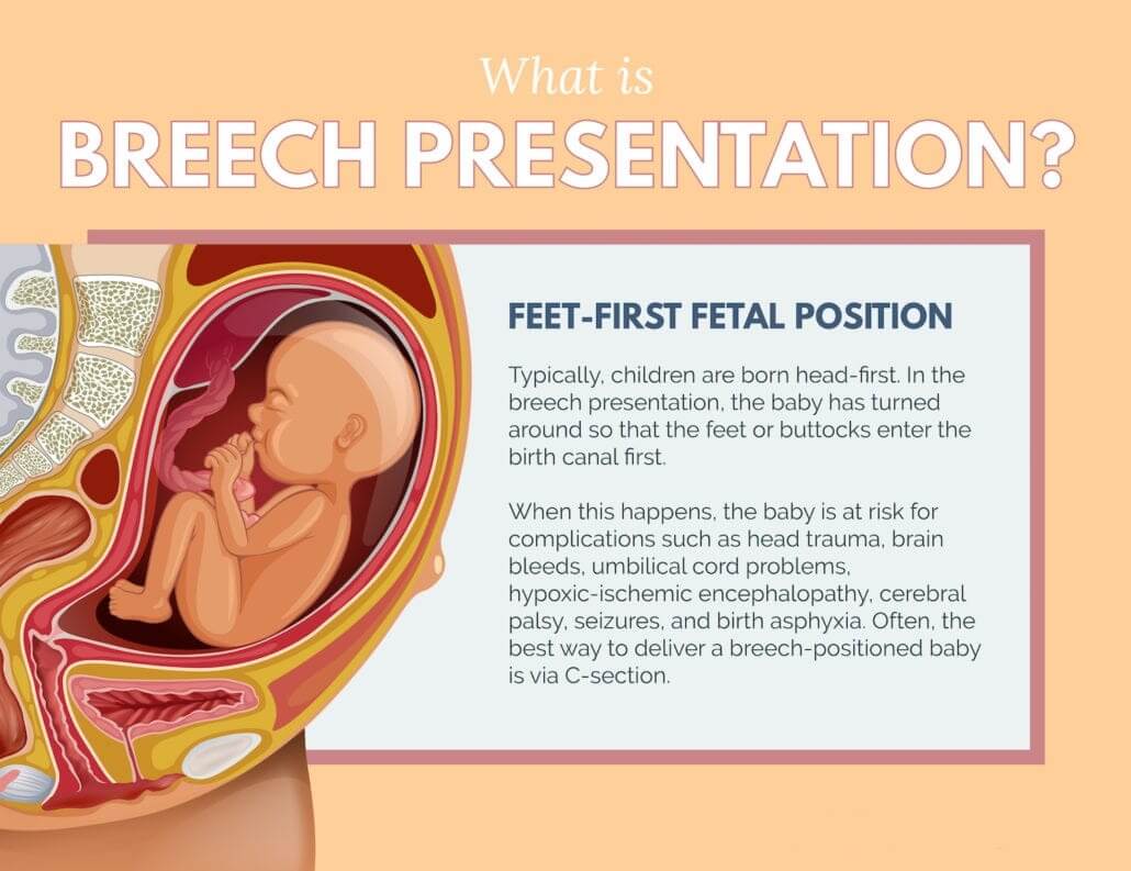 What Is Breech Presentation?
